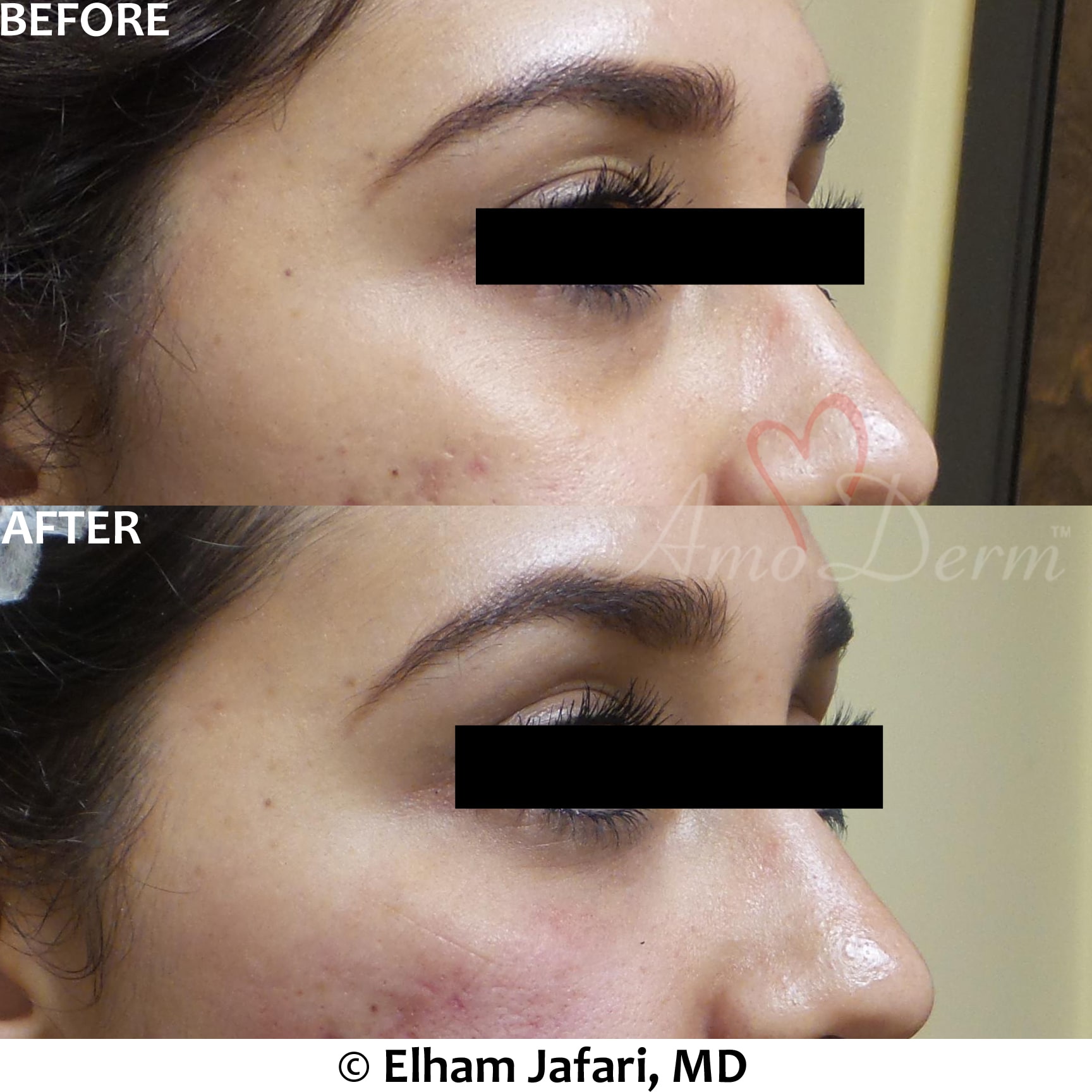 Treat dark circles & bags under eyes using fillers & lasers