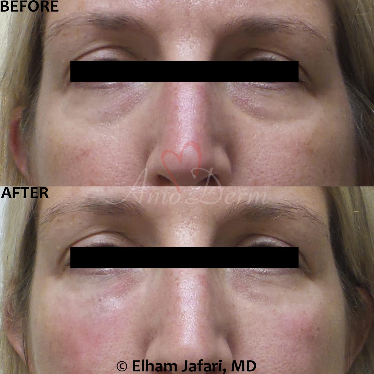 Treat dark circles & bags under eyes using fillers & lasers