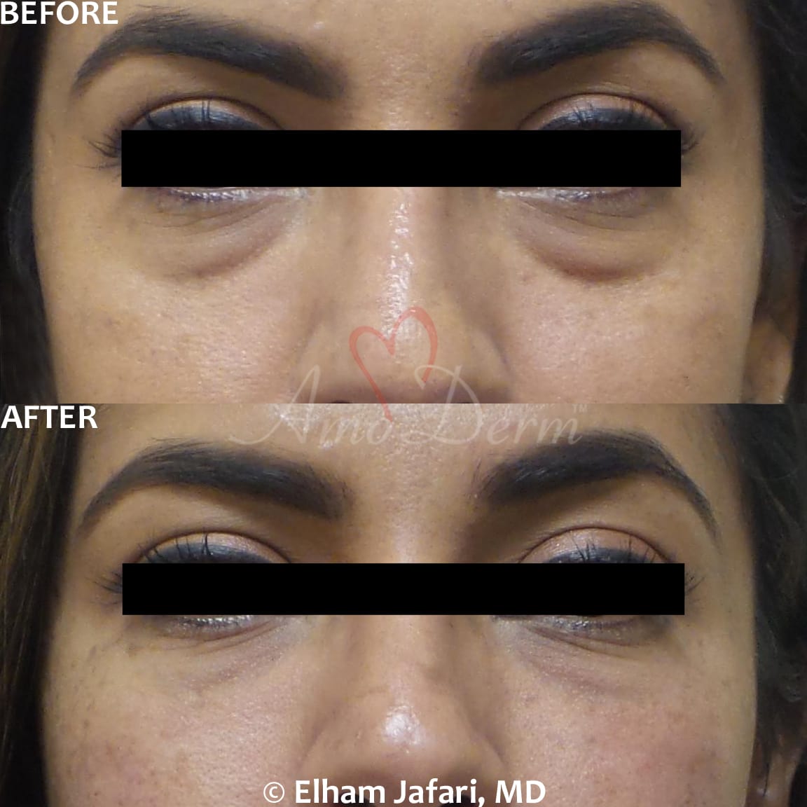 Treat dark circles & bags under eyes using fillers & lasers