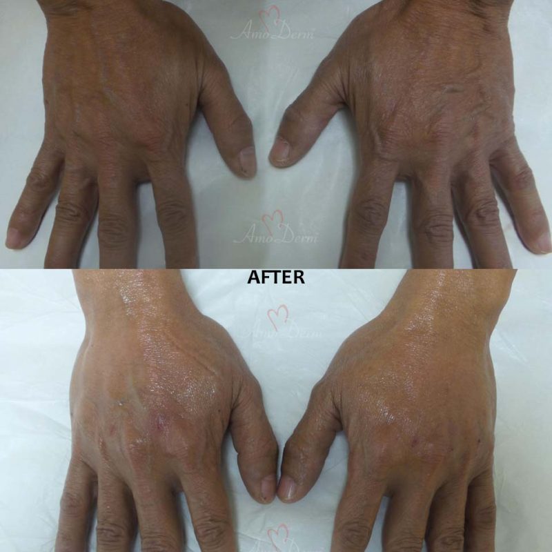 Hand Rejuvenation: Before &amp; After Gallery from Amoderm