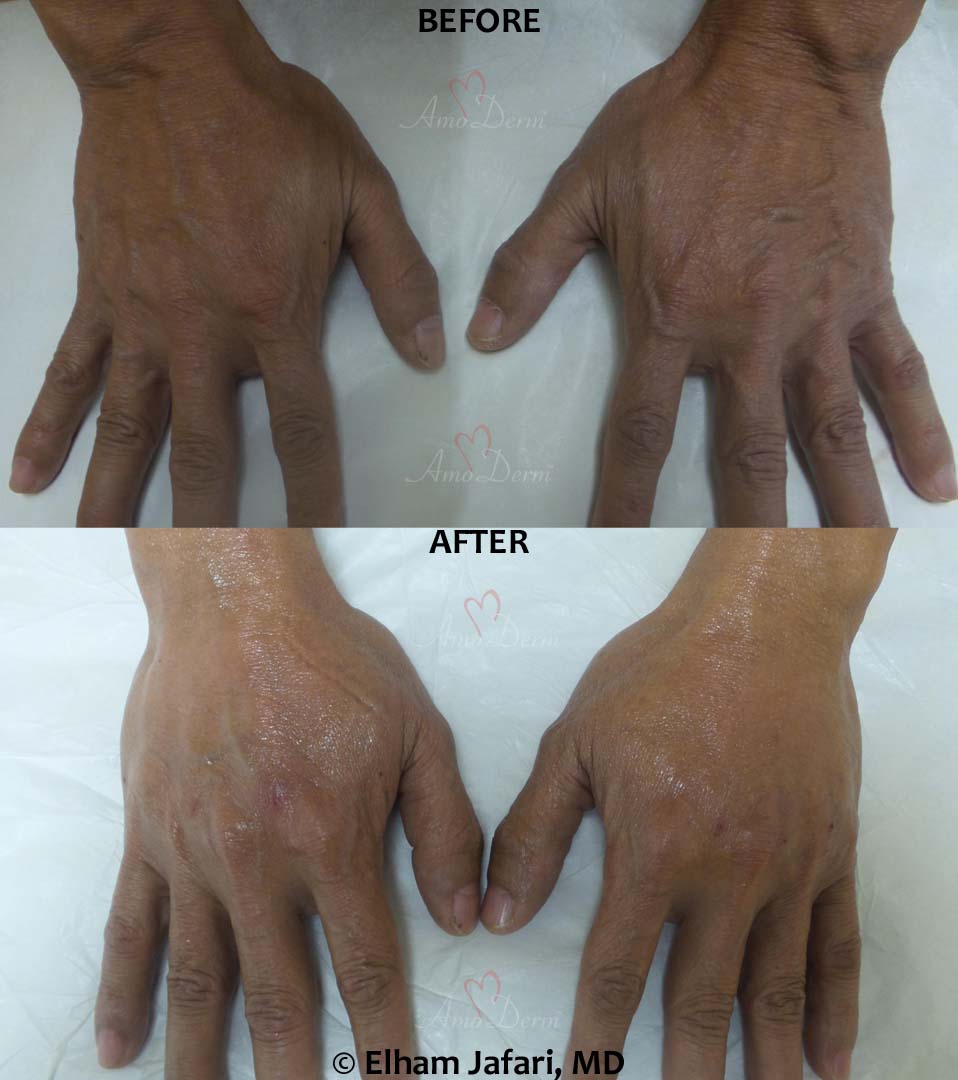 Irvine & Newport Beach Hand Rejuvenation Orange County Fillers