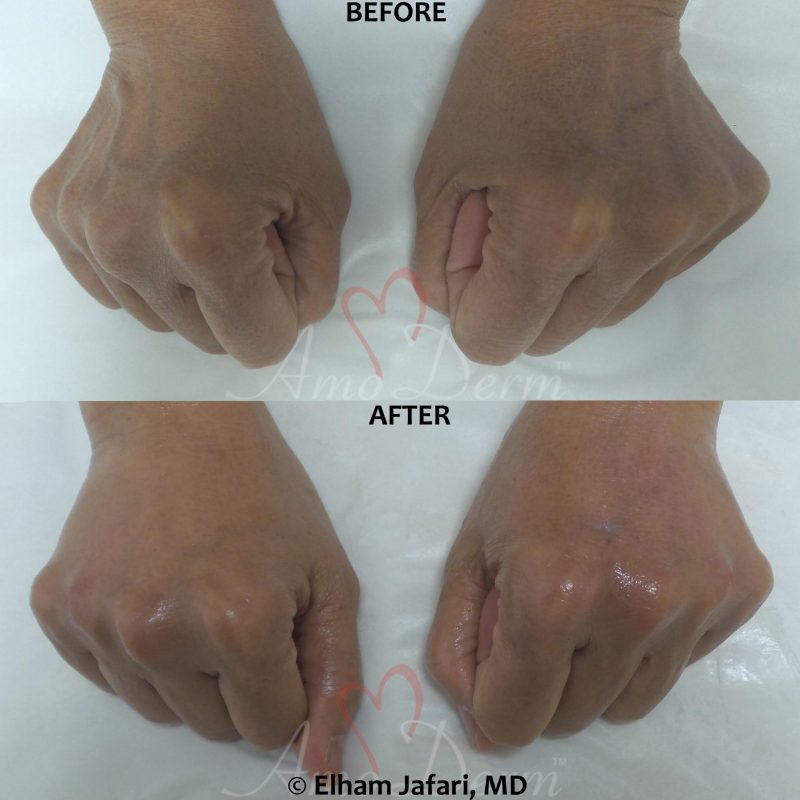 Hand rejuvenation with dermal filler injection