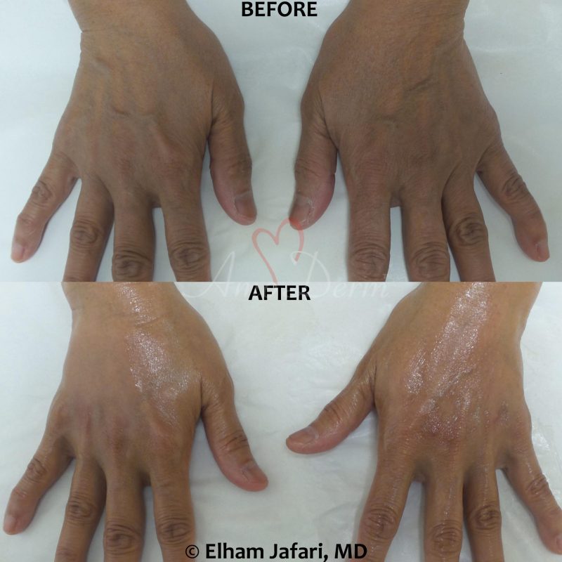 Hand rejuvenation with dermal filler injection