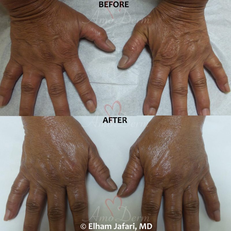 Hand rejuvenation with dermal filler injection