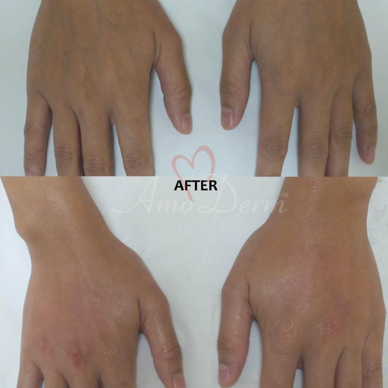 Hand Rejuvenation