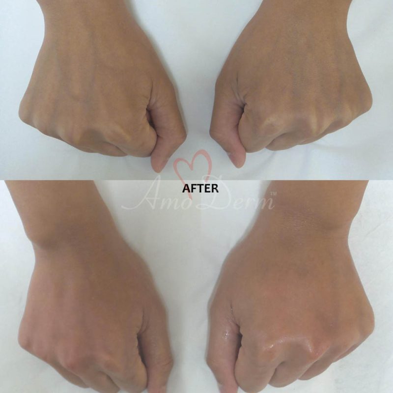 Hand Rejuvenation