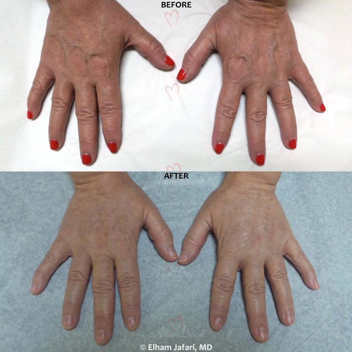 Hand Rejuvenation