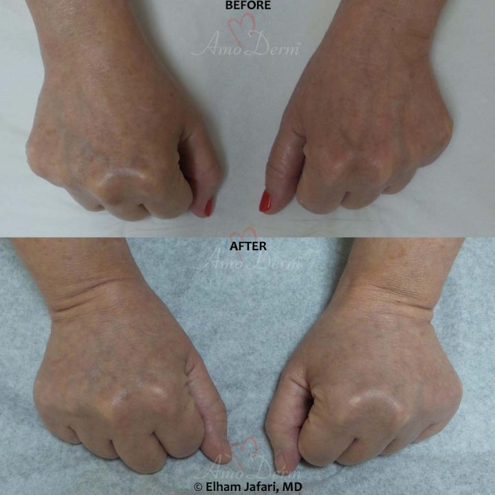 Hand Rejuvenation