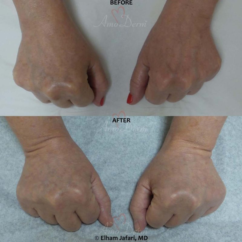 Hand Rejuvenation