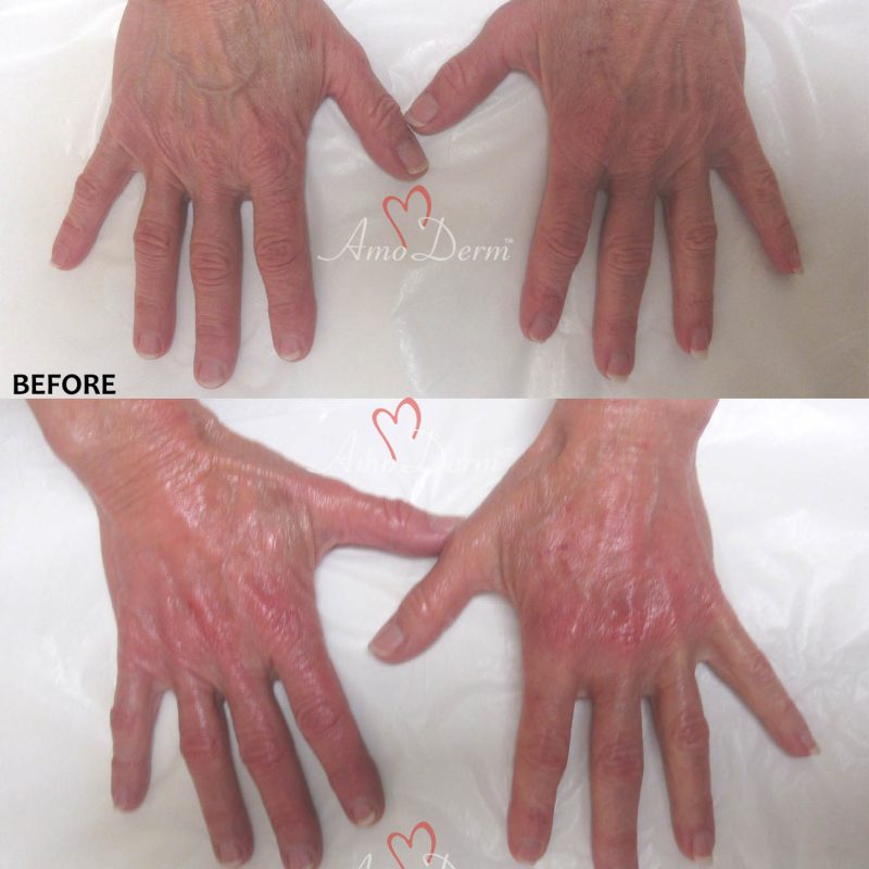 Hand Rejuvenation with Radiesse