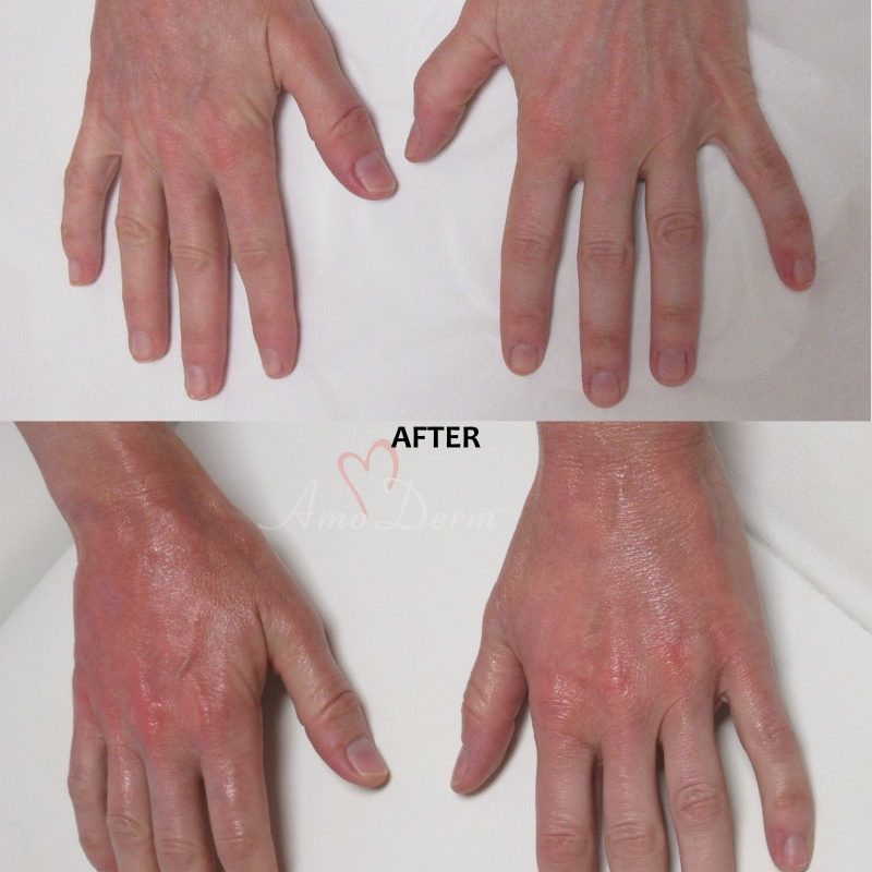 Hand Rejuvenation