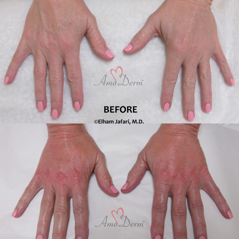 Hand Rejuvenation