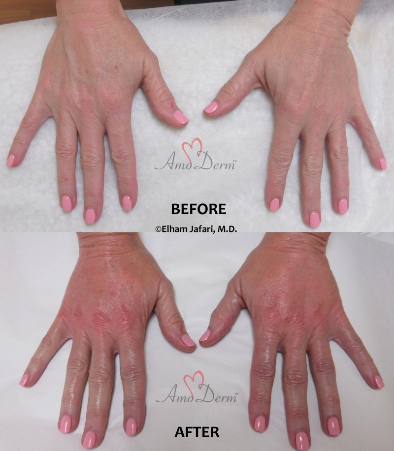 Irvine & Newport Beach Hand Rejuvenation Orange County Fillers