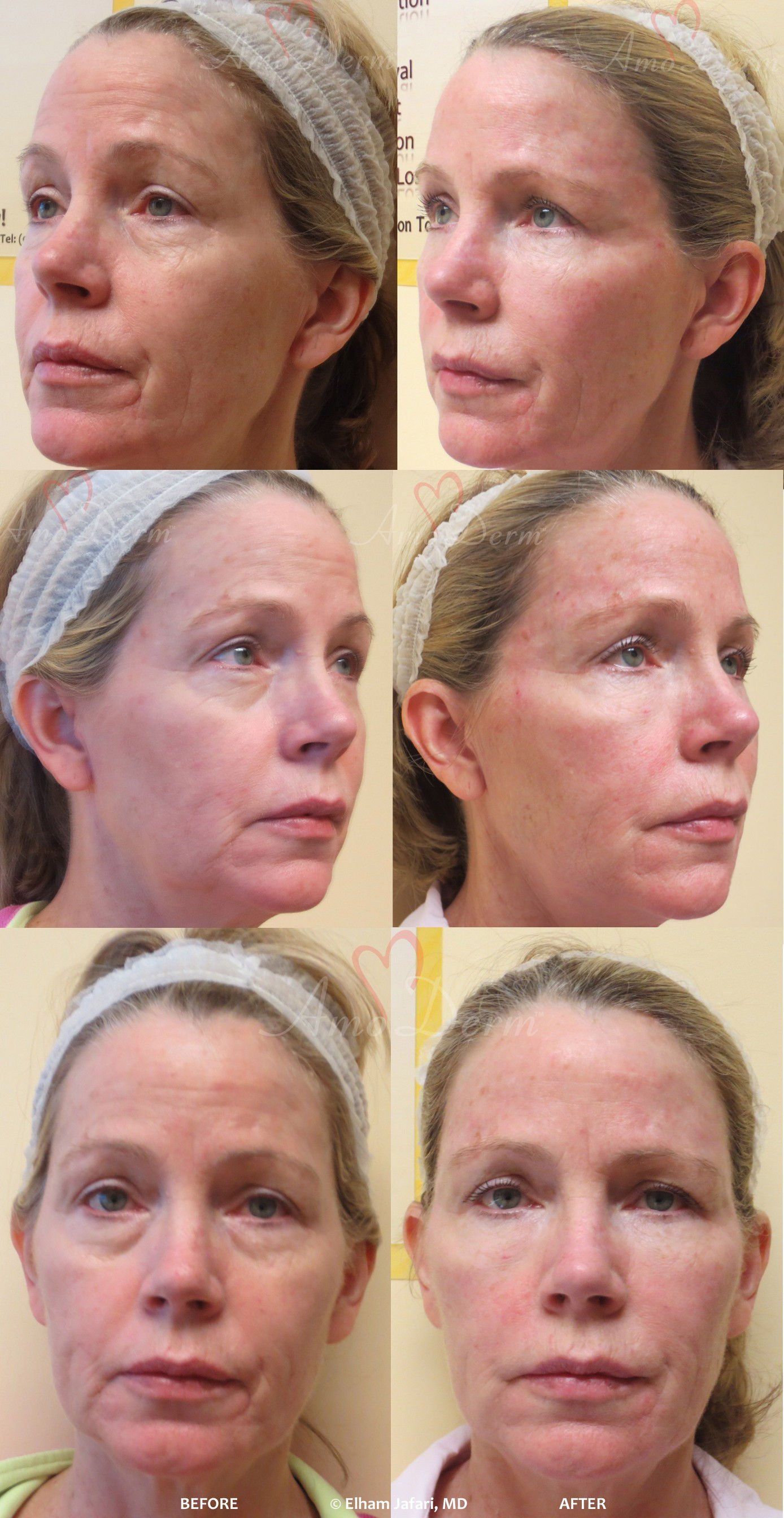 Irvine Botox® Newport Beach and Orange County Botox Cosmetic