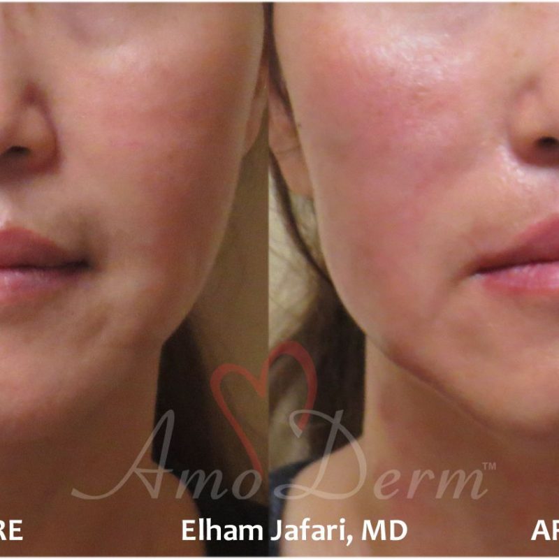 Thread Lift Cosmetic Treatments Before and After Pictures Thread Lift
