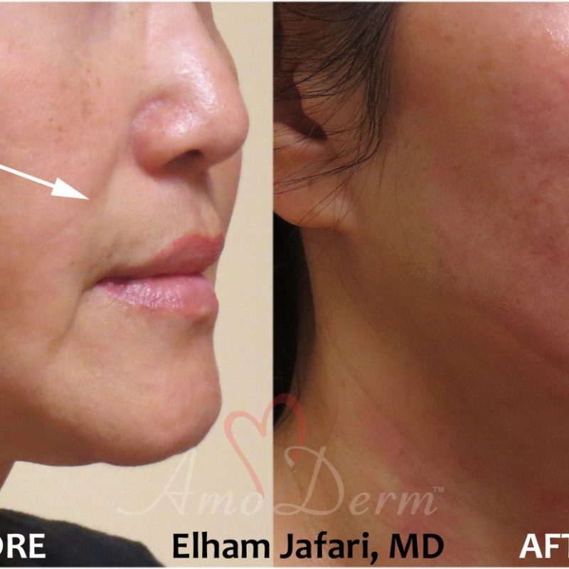 Thread Lift Cosmetic Treatments Before and After Pictures Thread Lift