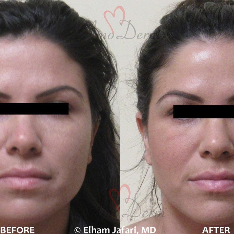 Jaw Slimming