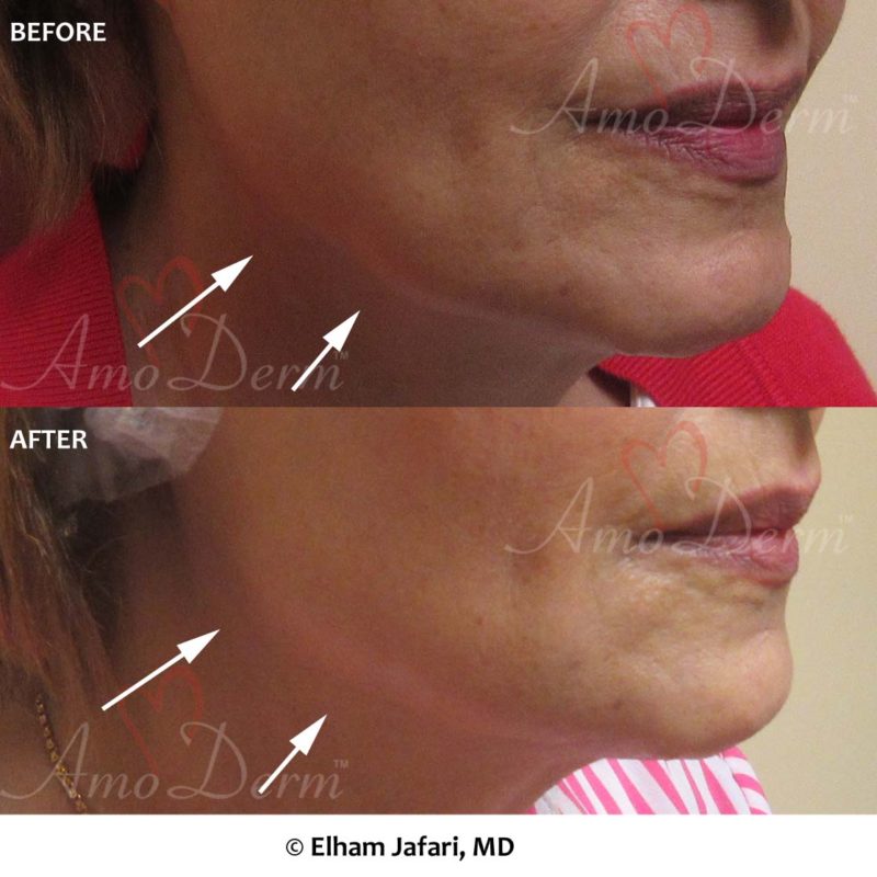 Jaw and Neck Lift
