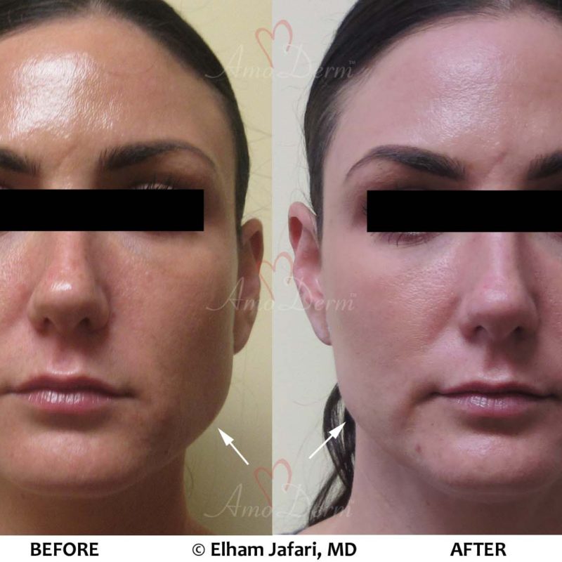 Jaw Slimming