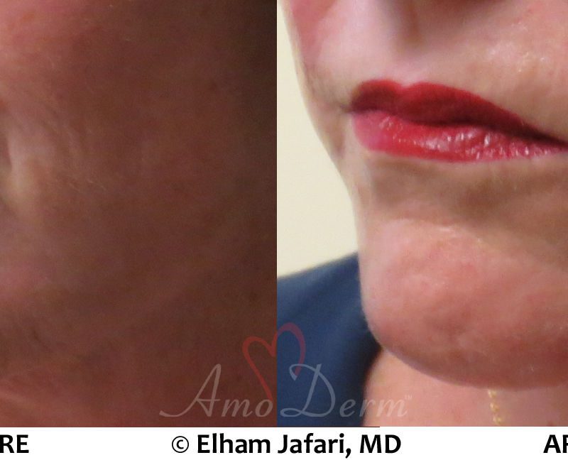 Thread Lift Treatments Before and After Pictures Thread Lift
