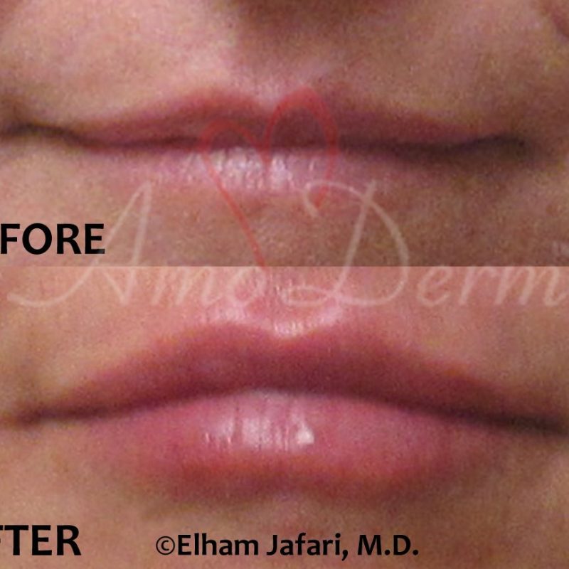 Lip Augmentation