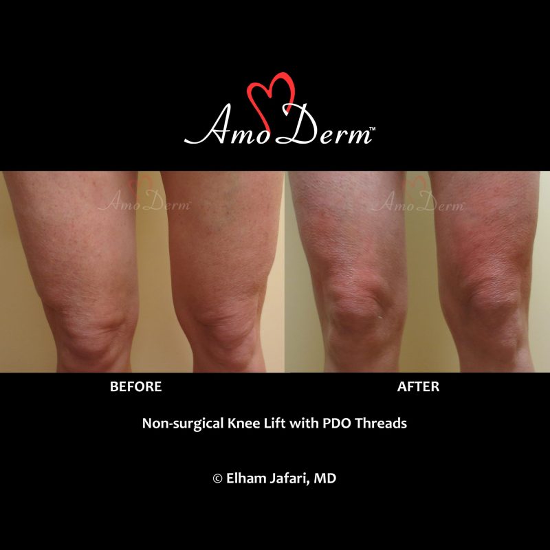 Non-surgical Knee Lift with PDO Threads Cosmetic Treatments Before and After Pictures Non-surgical Knee Lift with PDO Threads Amoderm : Before & After Gallery