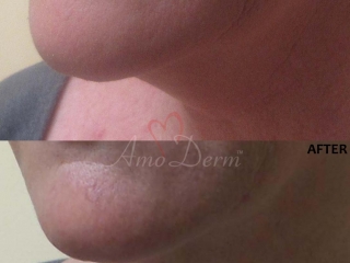 Kybella