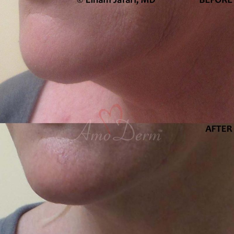 Kybella