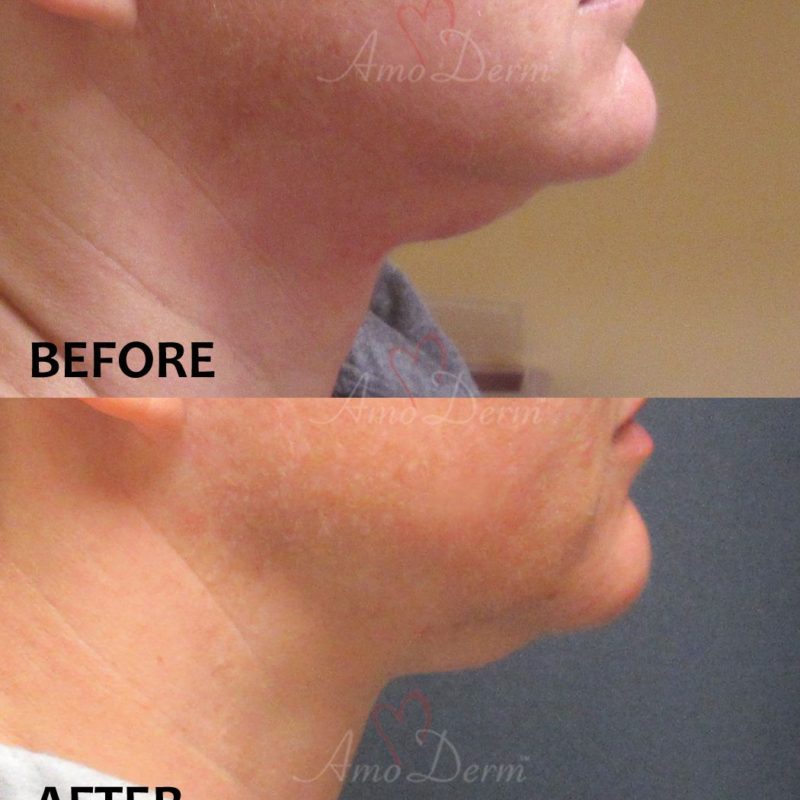 Kybella Amoderm Cosmetic Treatments