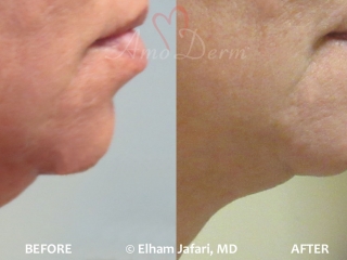 Kybella Double Chin
