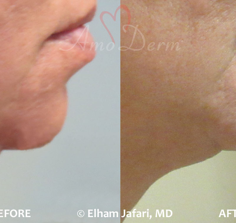 Kybella Double Chin