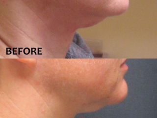 Non surgical &amp; permanent reduction of double chin (excessive submental fat) with Kybella