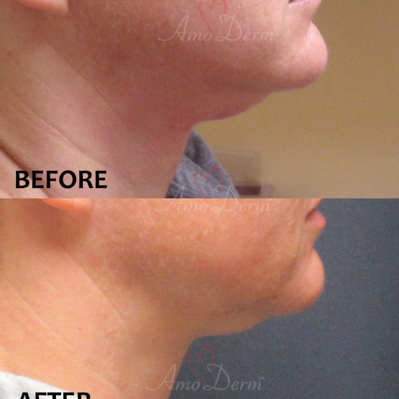 Non surgical &amp; permanent reduction of double chin (excessive submental fat) with Kybella