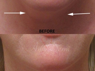 Kybella Double Chin