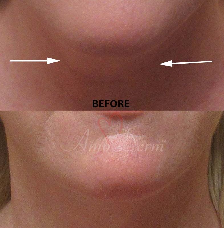 Kybella Double Chin