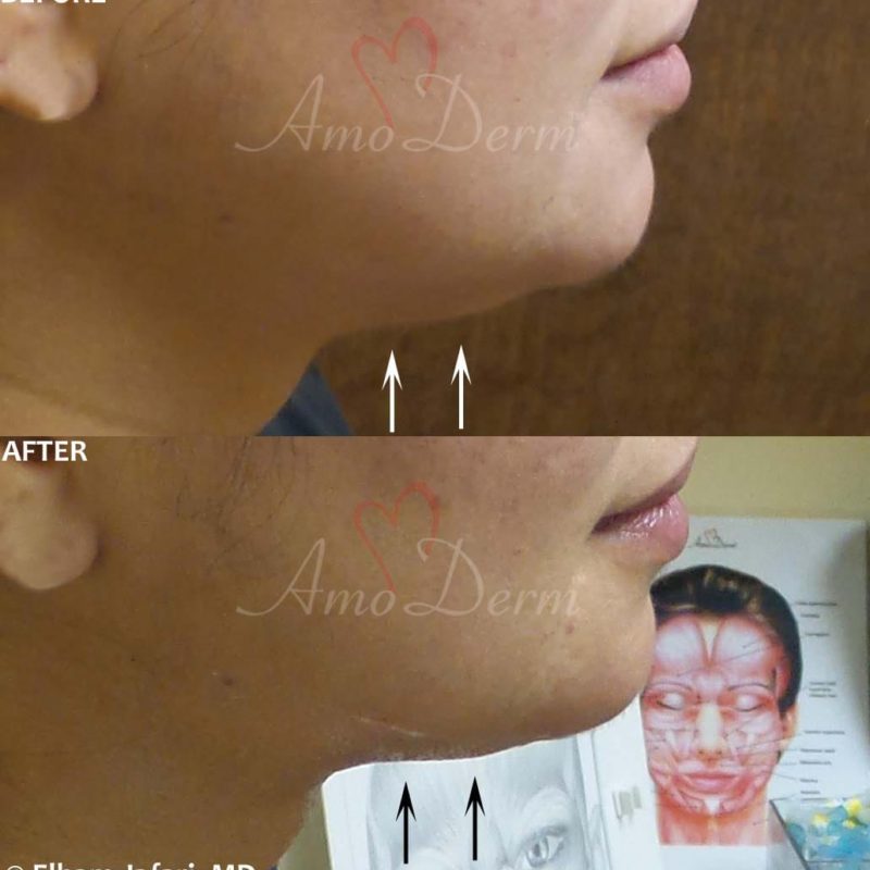 Kybella Double Chin