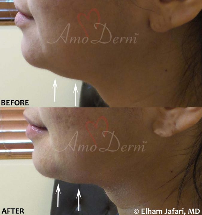 Kybella Double Chin