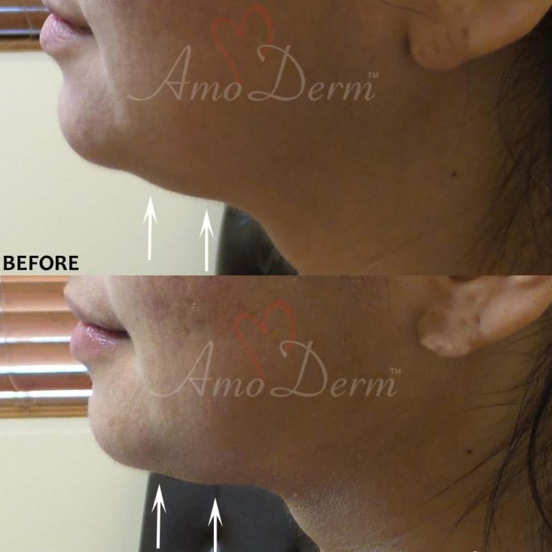 Kybella Double Chin
