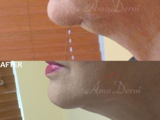 Non surgical &amp; permanent reduction of double chin (excessive submental fat) with Kybella