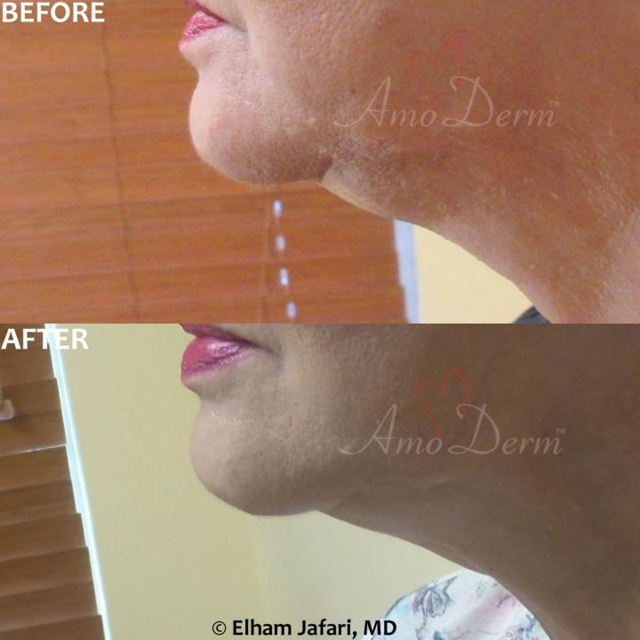 Non surgical & permanent reduction of double chin (excessive submental fat) with Kybella