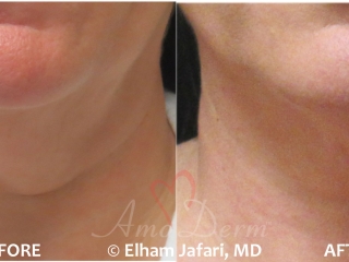 Kybella for Double Chin