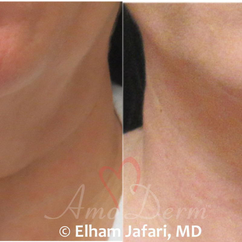 Kybella for Double Chin