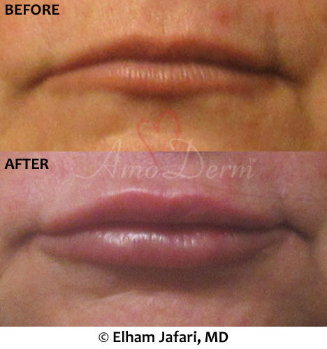 Lip Augmentation