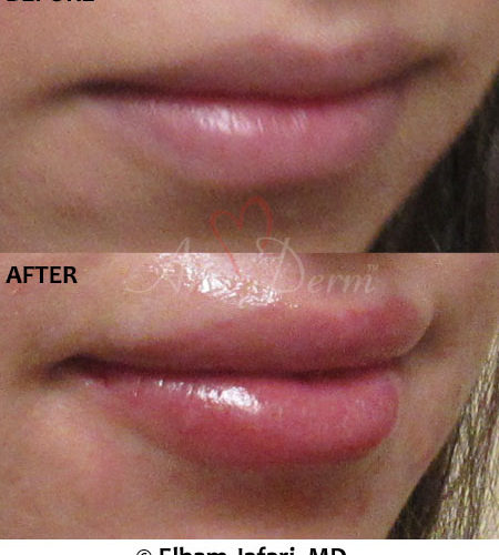 Lip Augmentation