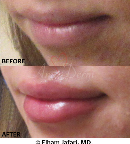 Lip Augmentation
