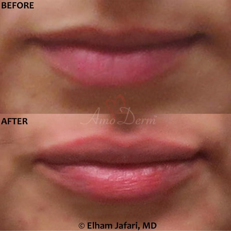 Lip Augmentation