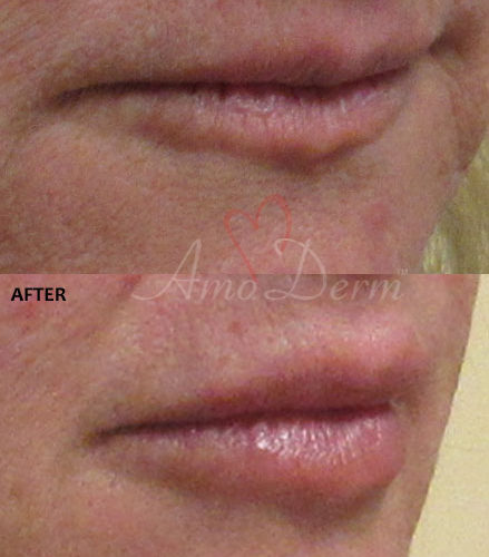 Lip Augmentation