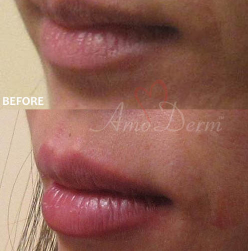 Lip Augmentation