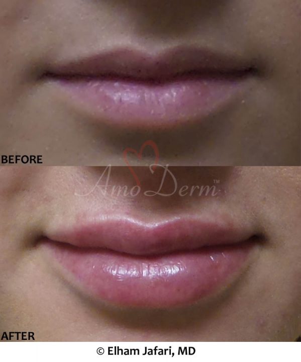Lip Augmentation
