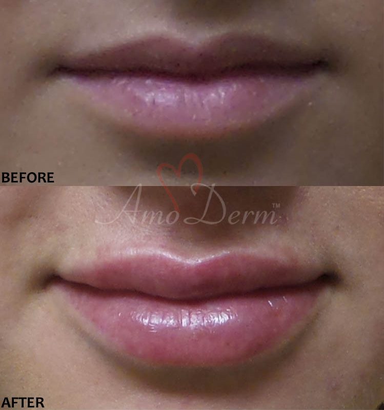 Lip Augmentation